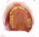 Small picture of Meth mouth damage